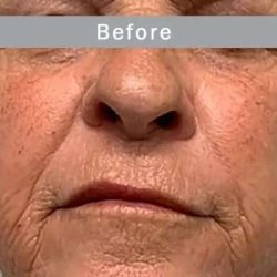 Morpheus8 Before & After Patient #407