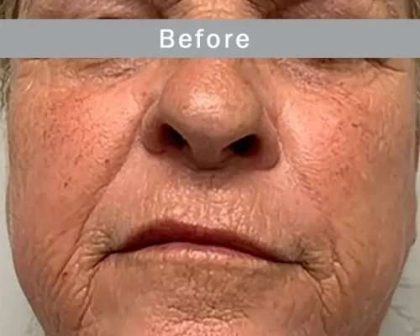 Morpheus8 Before & After Patient #407