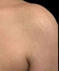 Morpheus8 Before & After Patient #422