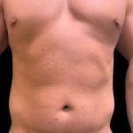 Smartlipo Vaser Lipo Before & After Patient #425