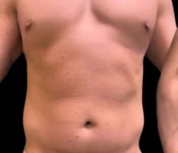 Smartlipo Vaser Lipo Before & After Patient #425