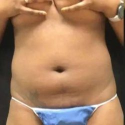 Smartlipo Vaser Lipo Before & After Patient #445