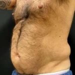 Smartlipo Vaser Lipo Before & After Patient #448