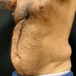 Smartlipo Vaser Lipo Before & After Patient #448