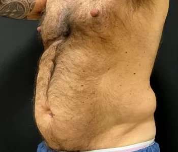 Smartlipo Vaser Lipo Before & After Patient #448