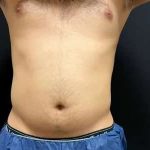 Smartlipo Vaser Lipo Before & After Patient #454