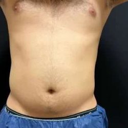 Smartlipo Vaser Lipo Before & After Patient #454