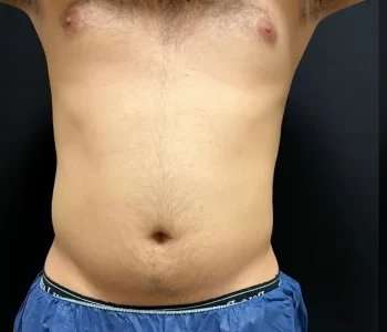 Smartlipo Vaser Lipo Before & After Patient #454