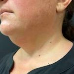 Smartlipo Vaser Lipo Before & After Patient #460