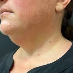 Smartlipo Vaser Lipo Before & After Patient #460