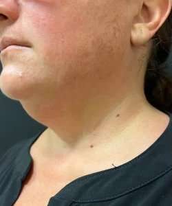 Smartlipo Vaser Lipo Before & After Patient #460