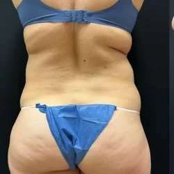 Smartlipo Vaser Lipo Before & After Patient #463