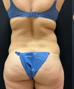 Smartlipo Vaser Lipo Before & After Patient #463
