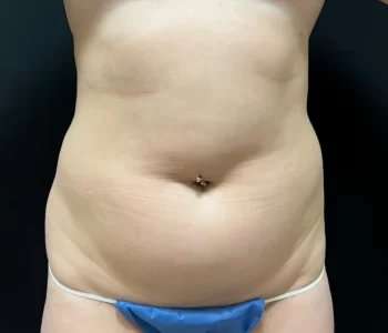 Smartlipo Vaser Lipo Before & After Patient #475