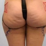 Smartlipo Vaser Lipo Before & After Patient #494