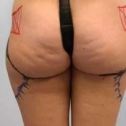 Smartlipo Vaser Lipo Before & After Patient #494