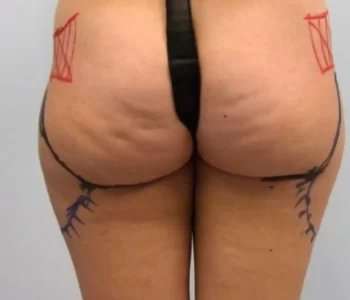 Smartlipo Vaser Lipo Before & After Patient #494