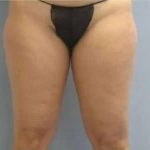 Smartlipo Vaser Lipo Before & After Patient #499