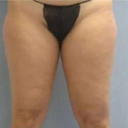 Smartlipo Vaser Lipo Before & After Patient #499