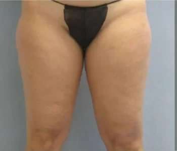 Smartlipo Vaser Lipo Before & After Patient #499