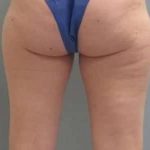 Smartlipo Vaser Lipo Before & After Patient #502