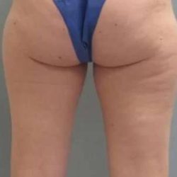 Smartlipo Vaser Lipo Before & After Patient #502
