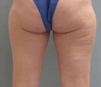 Smartlipo Vaser Lipo Before & After Patient #502
