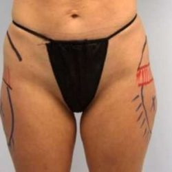 Smartlipo Vaser Lipo Before & After Patient #505