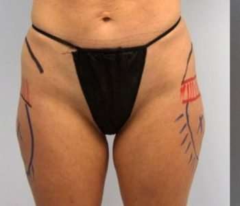 Smartlipo Vaser Lipo Before & After Patient #505