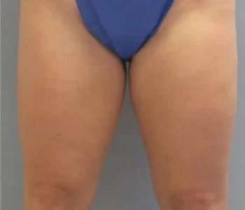 Smartlipo Vaser Lipo Before & After Patient #508