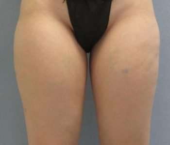 Smartlipo Vaser Lipo Before & After Patient #511