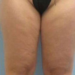 Smartlipo Vaser Lipo Before & After Patient #516