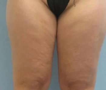 Smartlipo Vaser Lipo Before & After Patient #516