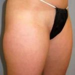 Smartlipo Vaser Lipo Before & After Patient #519