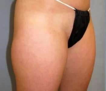 Smartlipo Vaser Lipo Before & After Patient #519