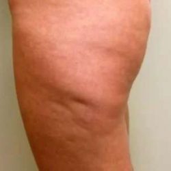 Smartlipo Vaser Lipo Before & After Patient #522