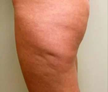 Smartlipo Vaser Lipo Before & After Patient #522