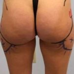 Smartlipo Vaser Lipo Before & After Patient #525