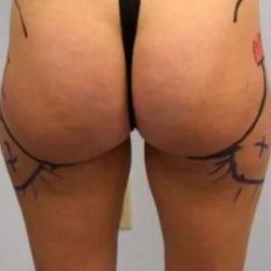 Smartlipo Vaser Lipo Before & After Patient #525