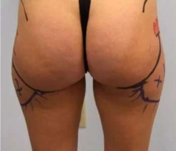 Smartlipo Vaser Lipo Before & After Patient #525