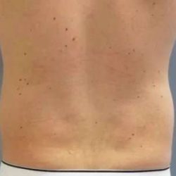 Smartlipo Vaser Lipo Before & After Patient #528