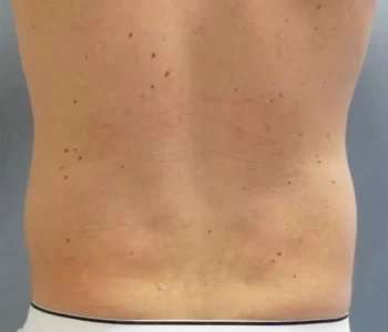Smartlipo Vaser Lipo Before & After Patient #528