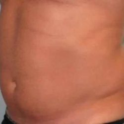 Smartlipo Vaser Lipo Before & After Patient #531