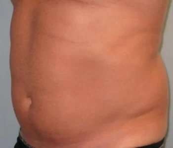 Smartlipo Vaser Lipo Before & After Patient #531