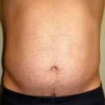 Smartlipo Vaser Lipo Before & After Patient #536