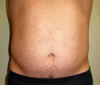 Smartlipo Vaser Lipo Before & After Patient #536