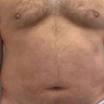 Smartlipo Vaser Lipo Before & After Patient #539