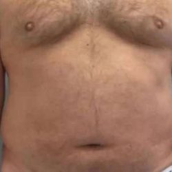Smartlipo Vaser Lipo Before & After Patient #539