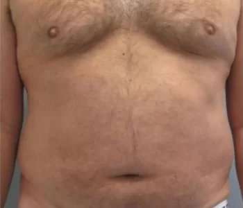 Gynecomastia Before & After Patient #2290