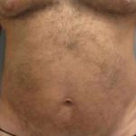 Smartlipo Vaser Lipo Before & After Patient #544